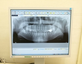 デジタルレントゲン