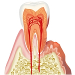 歯周病で抜けそうな歯