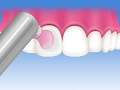 歯の表面のツヤ出し