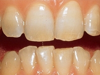 ホームホワイトイニング使用前