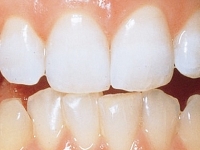 ホームホワイトニング使用後