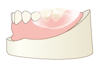 ノンクラスプデンチャー
